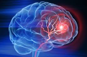 Stroke