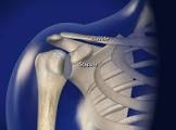 Shoulder Subluxation