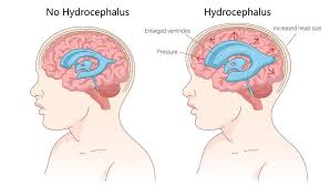 Hydrocephalus